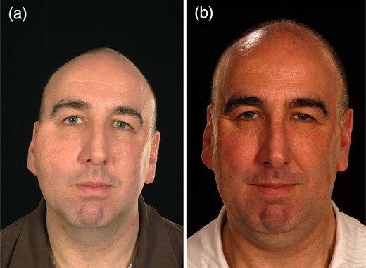 Case 2: (a) pre-treatment and (b) post-treatment.