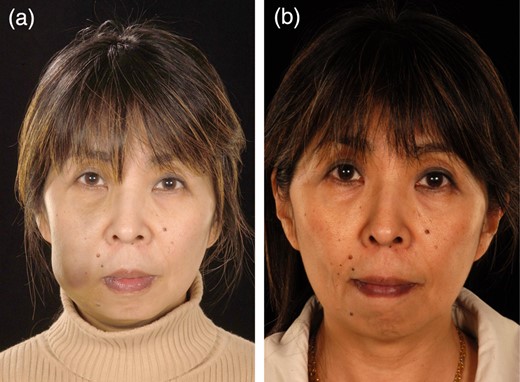 Case 3: (a) pre-treatment and (b) post-treatment.