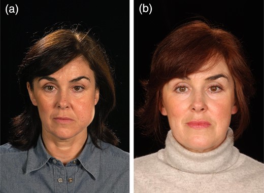 Case 4: (a) pre-treatment and (b) post-treatment.