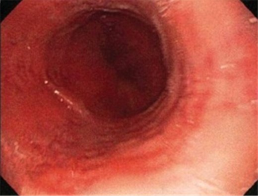 The image of linear erosional areas in middle and distal esophagus.