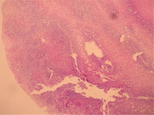 Eosinophilic infiltration in H–E ×10 esophagus mucosa.