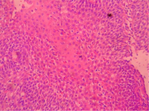 Eosinophilic infiltration in H–E ×40 esophagus mucosa.