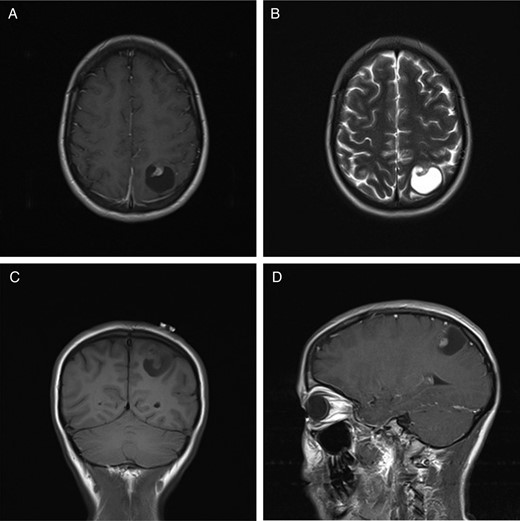 MRI of a supratentorial ependymoma that presents as a single cyst with a contrast-enhancing mural nodule. (A) T1-weighted axial image with contrast. (B) T2-weighted axial image. (C) T1-weighted coronal image without contrast. (D) T1-weighted image in a sagittal plane with contrast.