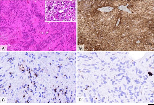 Morphological appearances of the ependymoma, WHO grade II. Haematoxylin and eosin-stained section (A) shows a moderately cellular tumour with frequent perivascular pseudorosettes and areas of stromal microcalcifications (inlet in A). Immunostaining for GFAP reveals widespread labelling in the tumour cells (B); whereas that for EMA shows frequent perinuclear dot-like labelling and accentuates occasional small ependymal canals (C). The Ki67 proliferation index in the tumour is low (D). Scale bar: 100 µm (A and B), 20 µm (C and D), 60 µm (inlet in A).