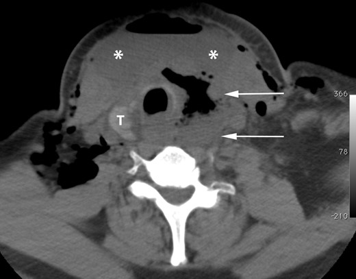 Axial CT image of the neck without oral or intravenous contrast demonstrates an air fluid collection in the left thyroid lobectomy bed (white arrows). Subcutaneous emphysema and a large anterior neck air fluid collection (asterisks) are also present. T, residual right lobe of the thyroid.