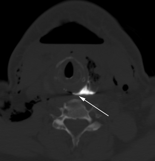 Axial CT image of the neck after fluoroscopy barium swallow demonstrates contrast pooling in the lobectomy bed with a fistulous connection to the esophagus (white arrow; image shown using a ‘bone window’ to clearly outline the barium contrast).