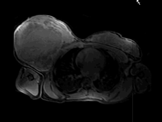 MRI T1f study after paramagnetic contrast showing a large mass occupying the entire right breast with extensive central necrosis.