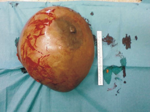 Surgical specimen.