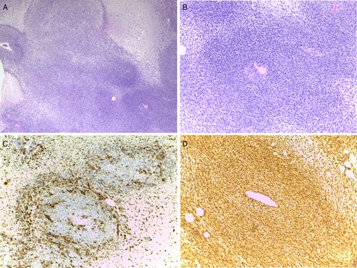 (A) Spindle cell proliferation with a hemangiopericitoid growth pattern (×4). (B) Nuclear pleomorphism and numerous mitoses (×10). (C) Focal expression of CK903, revealing epithelial differentiation (×10). (D) Strong and diffuse expression of vimentin (×10).