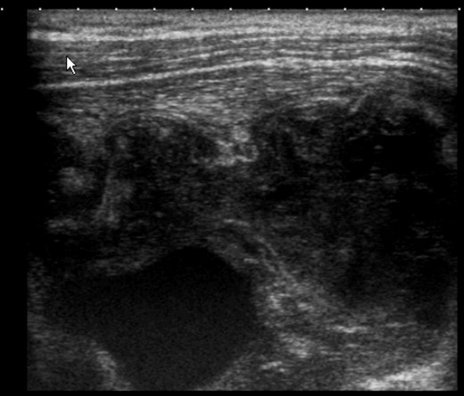 Ultrasound of the mastectomy bed showing a hypoechoic solid mass in subpectoral topography with signs of muscle invasion.