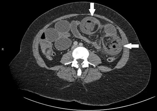The case's axial CT scan demonstrating the target sign.