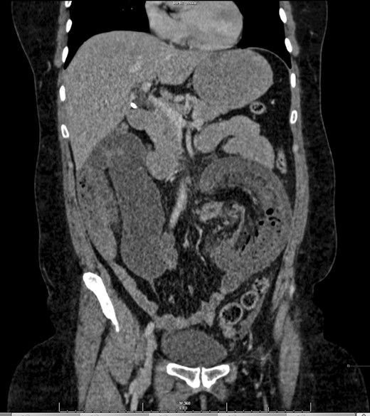 The case's CT–coronal view.