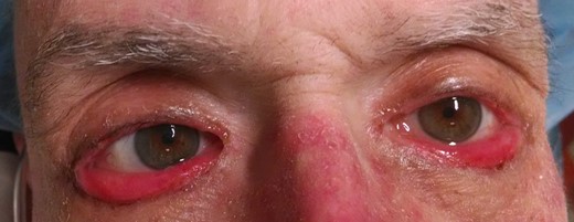 External photograph demonstrating cicatricial ectropion of bilateral lower eyelids associated with cetuximab use.