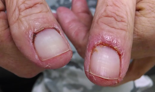 Paronychia associated with cetuximab use.