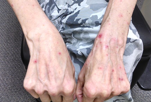 Maculopapular follicular rash of the upper extremities associated with cetuximab use.