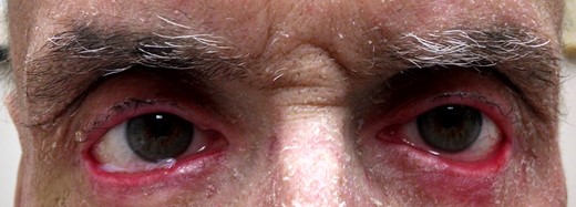 External photograph demonstrating improved lower eyelid height and contour 1 week after surgical repair of bilateral cicatricial ectropion with the amniotic membrane graft.