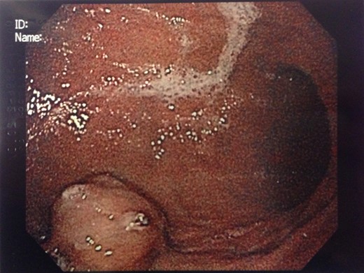 Endoscopic findings of gastric GT.