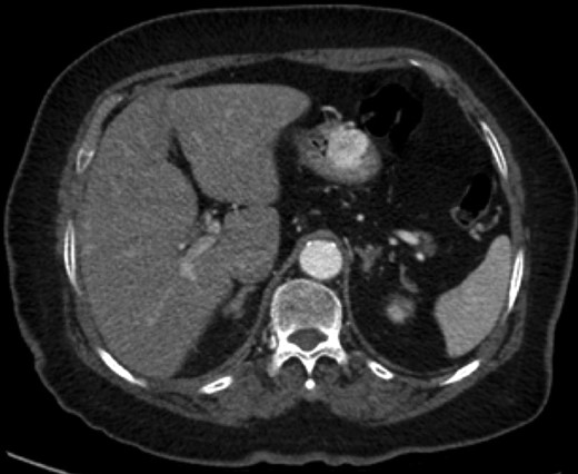 CT imaging of gastric GT.