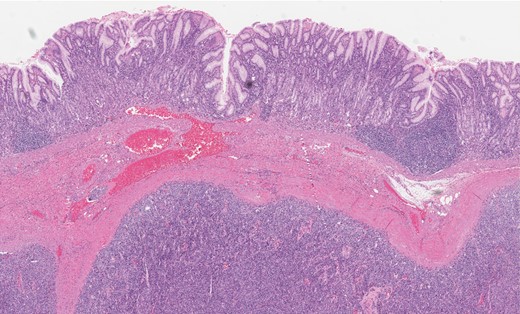 Gastric GT. Note the well-circumscribed submucosal lesion surrounding small vessels (H&E stain, ×20).