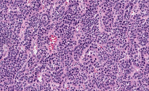Gastric GT. Note central round or oval nuclei with clear, eosinophilic cytoplasm (H&E stain, ×200).