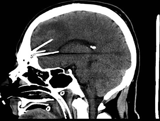 Preoperative sagittal CT demonstrating six needles traversing through the frontal lobe.