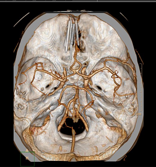 Axial CT 3D reconstruction showing six needles traversing intracranially and their relationship to vascular structures.