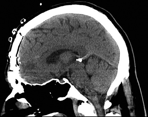 Sagittal postoperative CT scan demonstrating successful removal of the needles.