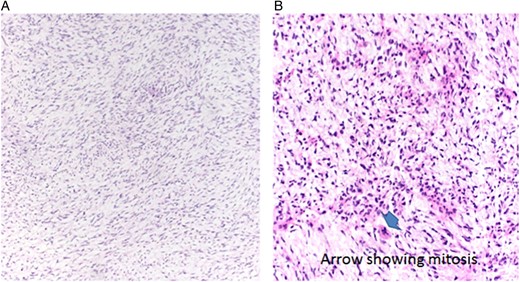 (A) Histological image of myxoma showing a cellular background with multiple spindle-shaped cells and bland nuclei with myxoid matrix. (B) Histological image of myxosarcoma showing hyperchromatic cells, atypia and mitosis (arrow), ×20, H&E