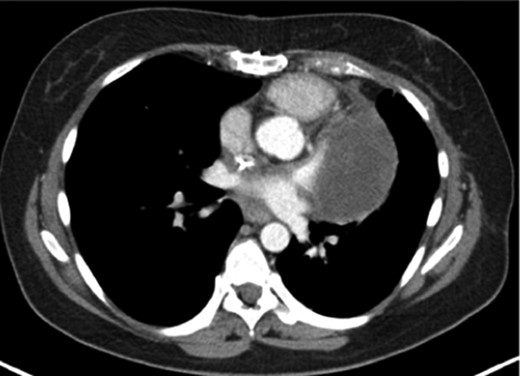 CT showing the tumour with infiltration of the main trunk of the left pulmonary artery with involvement of the hilus