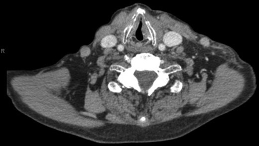 Computed tomography. A 67-year-old male with SSA. Findings: left vocal cord palsy indicated by the para-median position of the left vocal cord in comparison with the right. Technique: contrast-enhanced axial CT of the neck and thorax.