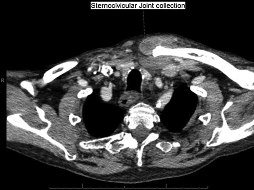 Computed tomography. A 67-year-old male with SSA. Findings: left sternoclavicular joint collection and closely associated superficial anterior chest wall, soft tissue swelling and oedema. The oedema can be seen to be spreading into the chest. Technique: contrast-enhanced axial CT of the neck and thorax.