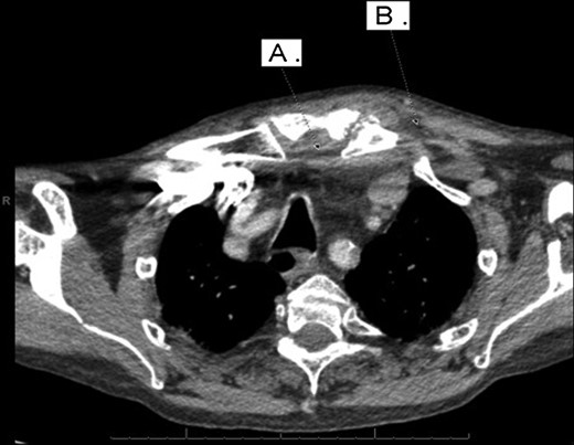 Computed tomography. A 67-year-old male with SSA. Findings: soft tissue oedema of the chest seen retrosternally (marker A) and superficially on the left anterior chest (marker B) as well as evidence of mediastinal lymph node enlargement. Technique: contrast-enhanced axial CT of the neck and thorax.