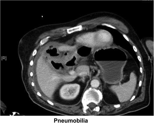 Transverse section from abdominal CT showing pneumobilia.