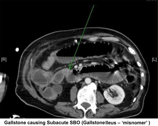 Transverse section from abdominal CT showing a small bowel obstruction with arrow indicating an intraluminal gallstone.