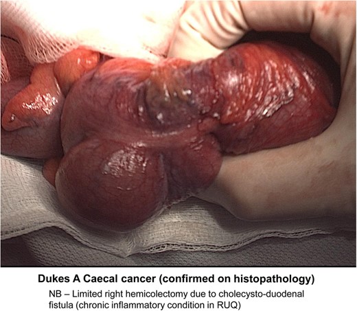 Intraoperative image indicating a caecal mass.