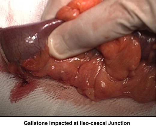 Intraoperative image indicating a 3-cm gallstone abutting the ileocaecal valve.