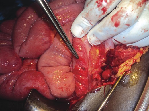 A peroperative view showing the colonic perforation (tip of the forceps).