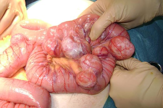 Intra-operative photography demonstrating multiple jejunal diverticula. Note that the diverticula arise at the mesenteric border and are clustered around proximal jejunum.