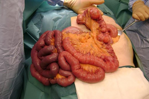Intra-operative photography demonstrating jejunal diveritcula proximally and presence of altered blood in the small bowel distal to these diverticula.