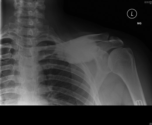 Preoperative radiograph.