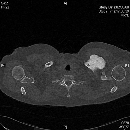 Preoperative CT scan, axial view showing the extent of the tumour.