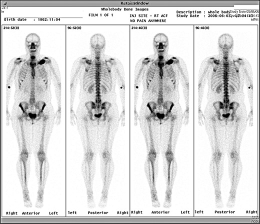 Preoperative bone scan.