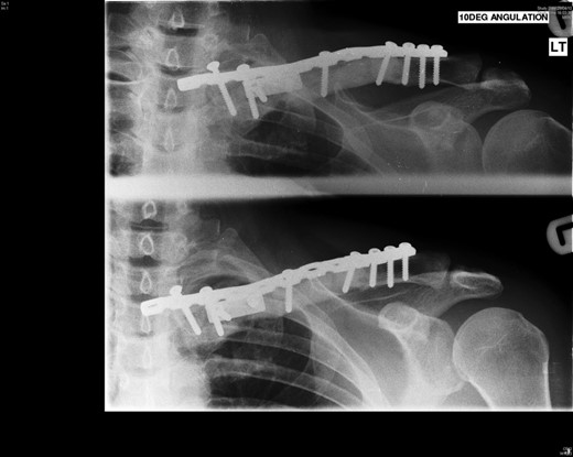 Follow-up radiograph at 20 months.