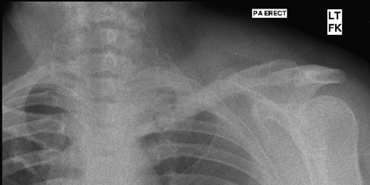 Follow-up radiograph at 76 months.