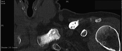 Follow-up CT at 76 months.