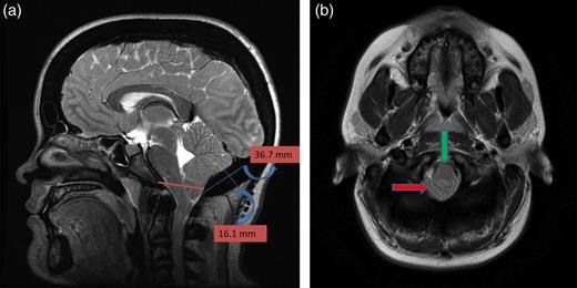 (a) Sagittal T2-weighted image showing cerebellar tonsillar herniation and diffuse thickening of the occipital bone. (b) Axial T1-weighted image showing compression on the upper cervical spinal cord (green arrow) and cerebellar tonsillar herniation (red arrow).