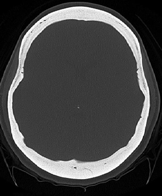 Axial CT image (bone window) showing diffuse calvarial thickening and loss of the medullary space.