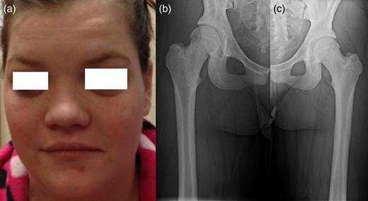 Patients' picture showing midfacial hypoplasia on the face (a), x-ray graphy of the right femur (b) and x-ray of left femur (c) showing diffuse cortical thickening.
