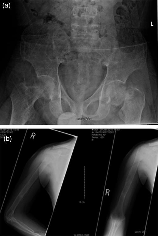(a) Left femoral neck displaced subcapital fracture and (b) right humeral shaft segmental fracture.