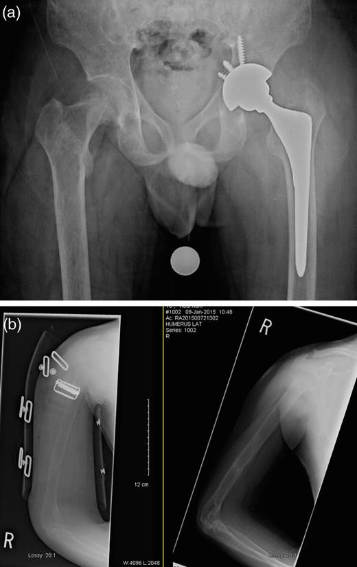 (a) Left THR and (b) right humerus in a brace.